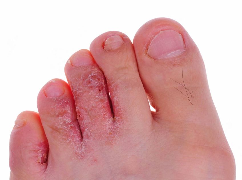 Best Essential Oils for Athlete's Foot