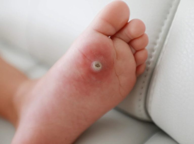6 Best Essential Oils for Warts: A Natural Approach to Clear Skin