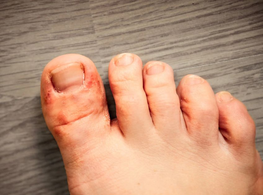 5 Effective Home Remedies for Athlete's Foot Natural Relief That Works