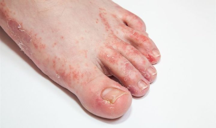5 Home Remedies That May Help Treat Athlete’s Foot