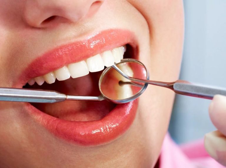 How to Remove Plaque and Tartar: Effective Home Treatments for a Healthy Smile