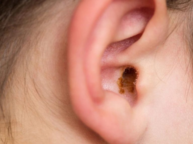 How to Safely Remove Earwax at Home: Remedies and What to Avoid