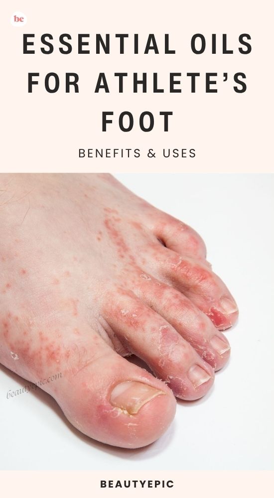 Essential Oils for Athlete’s Foot