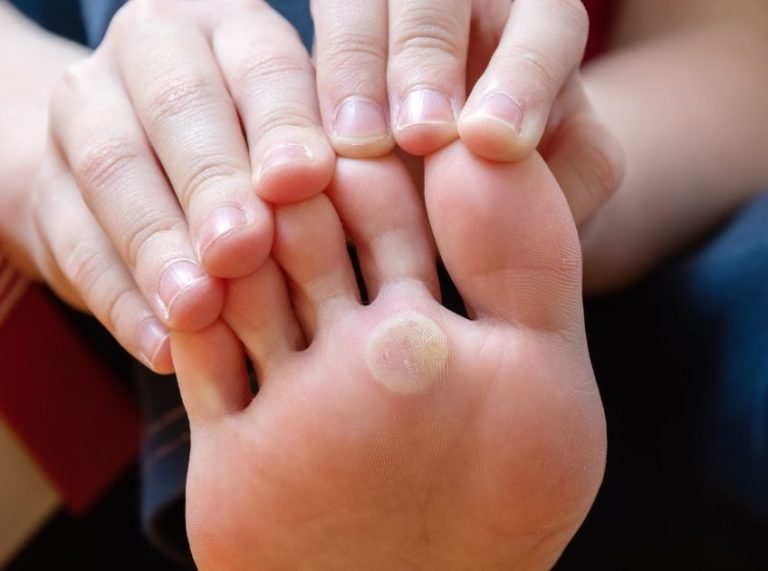 How to Get Rid of Corns at Home: Safe, Effective, and Natural Remedies