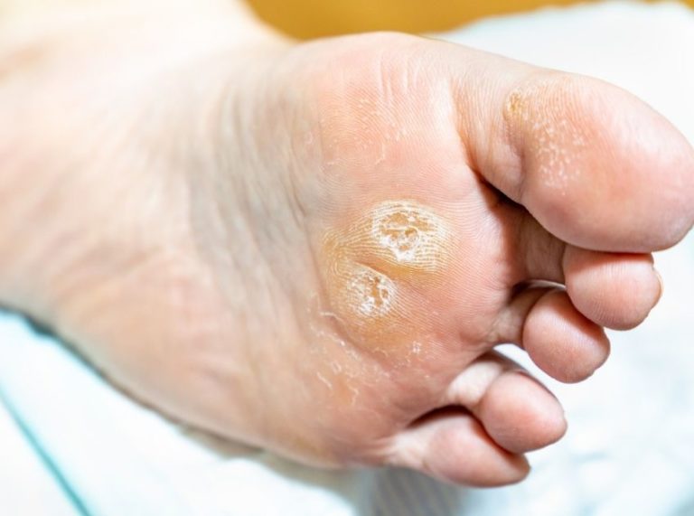 10 Best Essential Oils for Corns: Natural Remedies for Smooth, Pain-Free Feet