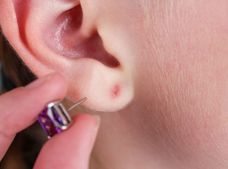 How to Treat an Infected Ear Piercing Safely at Home
