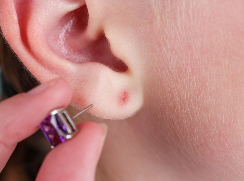 How to Treat an Infected Ear Piercing