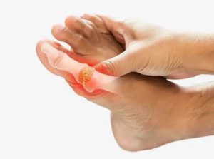 essential oils for gout