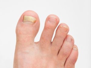 essential oils for toenail fungus