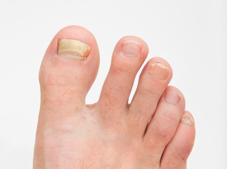 Essential Oils for Toenail Fungus: Do They Really Work? Remedies & Prevention