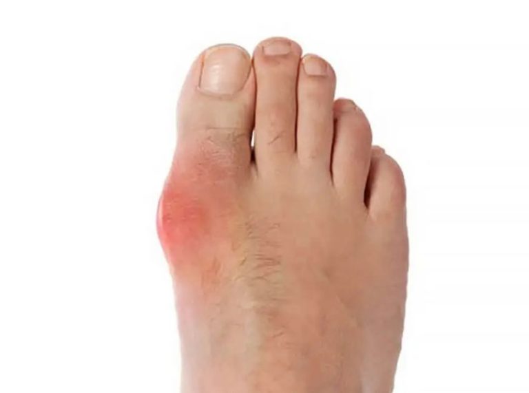 What to Eat (and Avoid) If You Have Gout