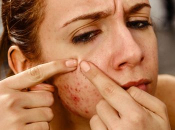 herbs for acne