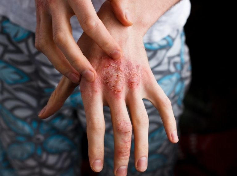 Herbs for Eczema: Which Are Worth Trying?