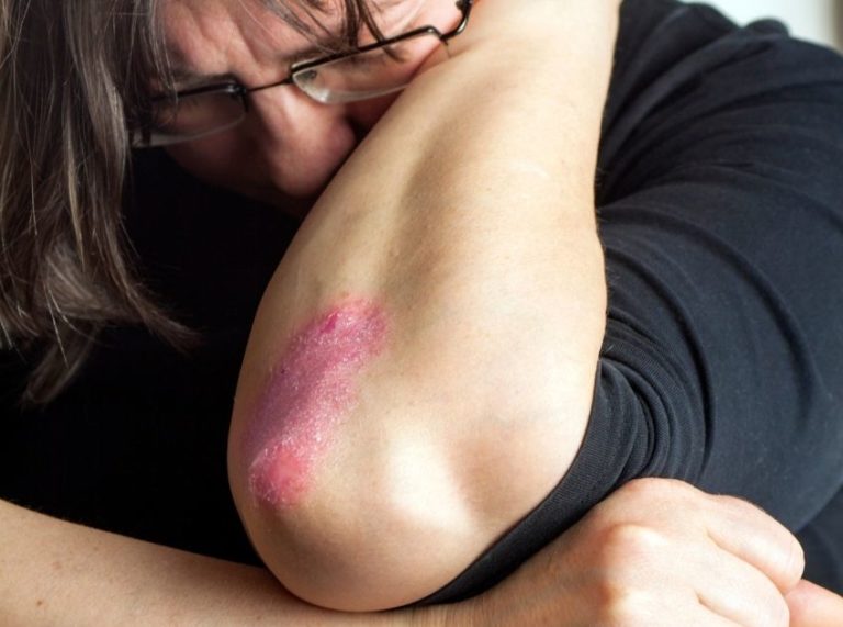 Herbs for Psoriasis: Topical Herbal Treatments