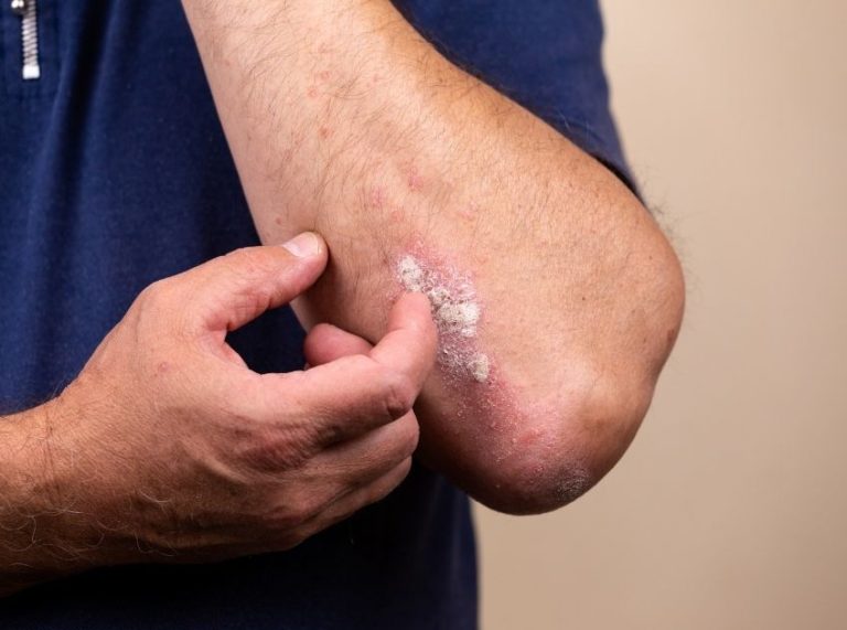 Can Goat’s Milk Soap Treat Eczema?