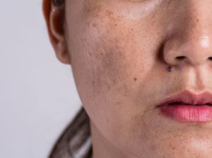7 Effective Home Remedies for Dark Spots