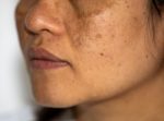 how to treat skin hyperpigmentation naturally