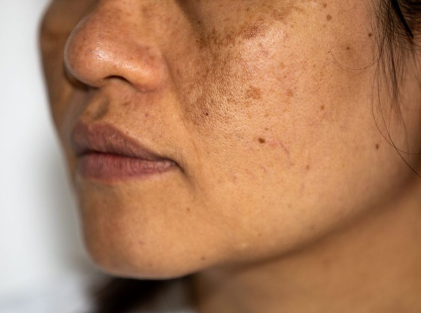 how to treat skin hyperpigmentation naturally