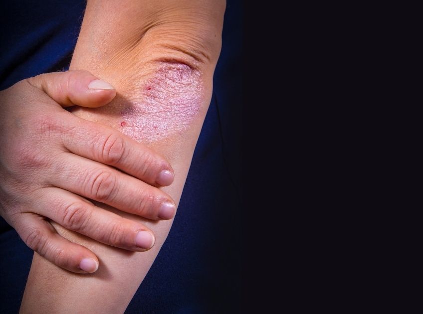 Vitamins and Supplements for Psoriasis