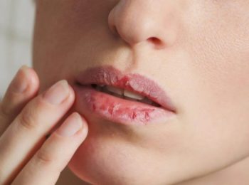 Home Remedies for Chapped Lips