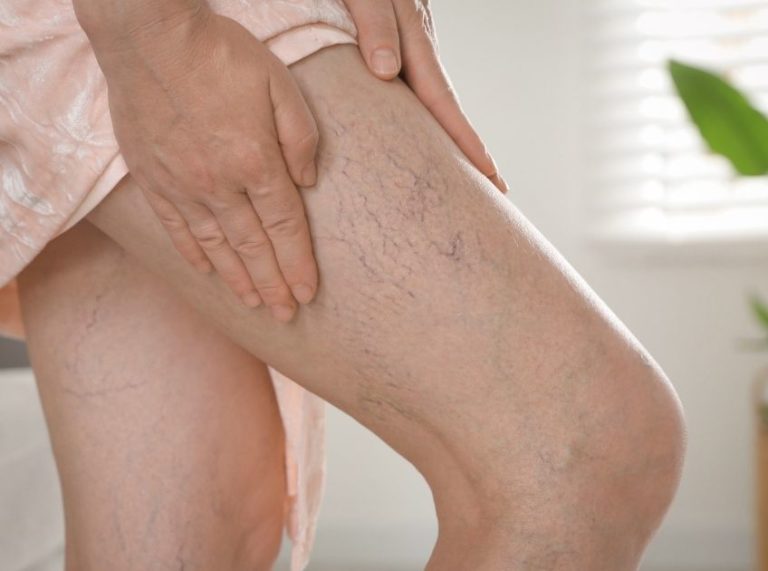 9 Proven Tips to Treat Varicose Veins at Home