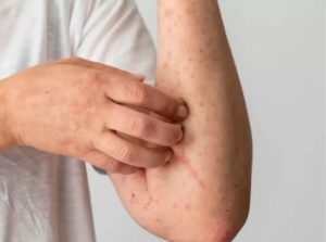 home remedies for scabies