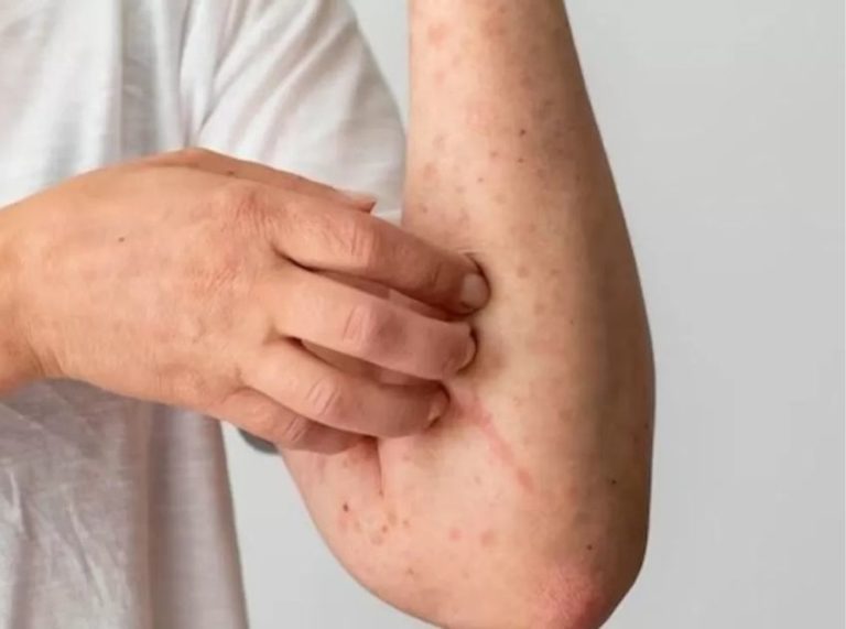 Natural Relief for Scabies: Home Remedies & Essential Care