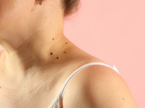 how to care for your skin after mole removal