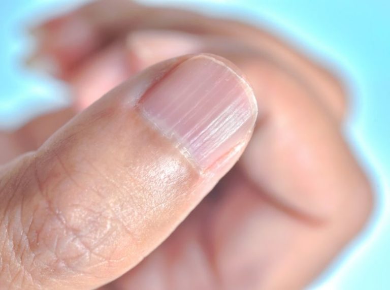 What Your Nail Ridges Reveal About Your Health (and When to Worry)