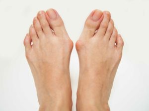 How to Reduce Bunion Pain at Home Without Surgery