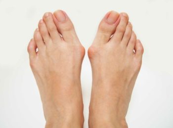 home remedies for bunion pain relief