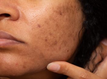dark spots on face