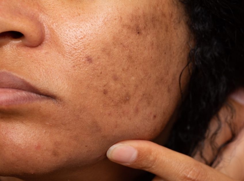 dark spots on face