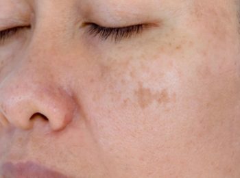 remove dark spots on face naturally