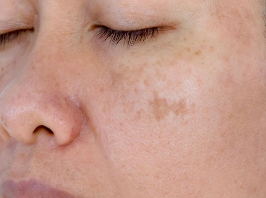 remove dark spots on face naturally