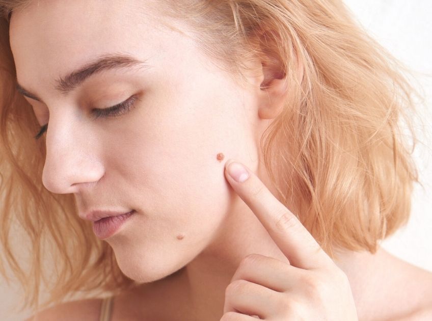 apple cider vinegar vs garlic for moles