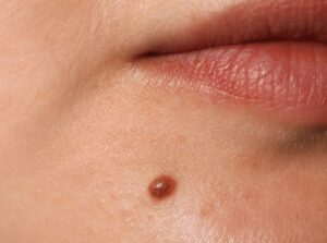 Castor Oil vs Tea Tree Oil for Moles: What Actually Works?