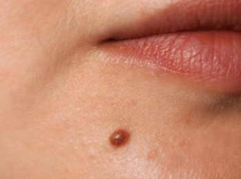 castor oil and tea tree oil for moles