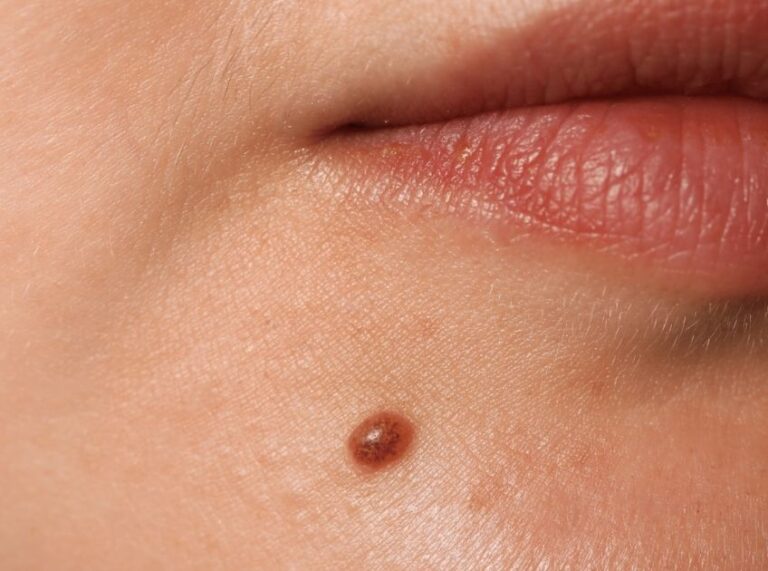 Castor Oil vs Tea Tree Oil for Moles: What Actually Works?