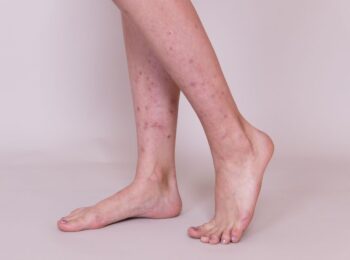 dark spots on legs