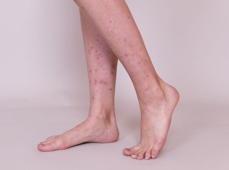 Dark Spots on Legs: Causes, Treatments & How to Remove Them