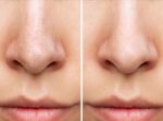 how to clear large nose pores
