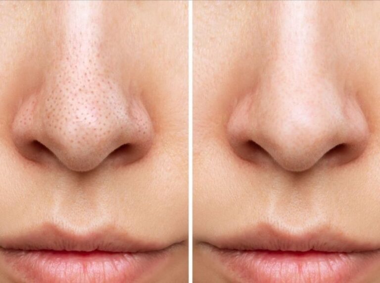 How to Clean Enlarged Nose Pores: 13 Easy Tips