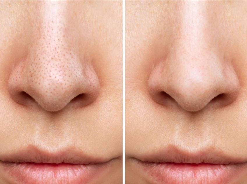 how to clear large nose pores
