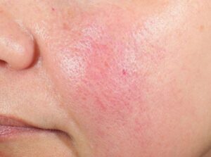 how to restore your skin barrier