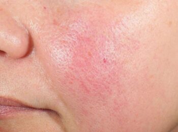 how to restore your skin barrier