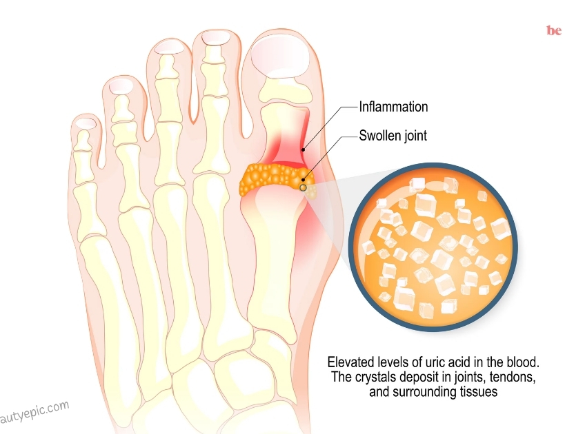 how to remove gout crystals from joint